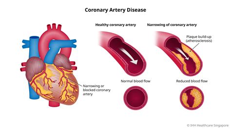 Coronary Heart Disease .